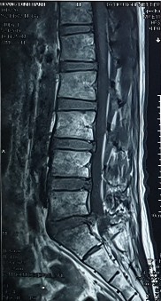 Hình ảnh thoát vị đĩa đệm trên phim chụp MRI 19