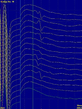 Hình ảnh dẫn truyền vận động của dây thần kinh chày Hình ảnh sóng F của 2