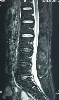 Hình ảnh thoát vị đĩa đệm trên phim chụp MRI 20