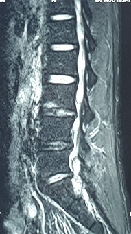 Hình ảnh thoát vị đĩa đệm trên phim chụp MRI 21