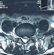 Hình ảnh thoát vị đĩa đệm trên phim chụp MRI 22