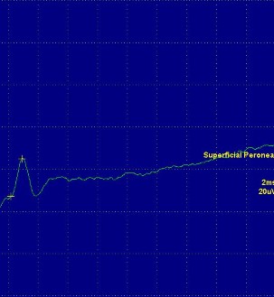 Hình ảnh dẫn truyền vận động của dây thần kinh mác nông Hình ảnh dẫn 3