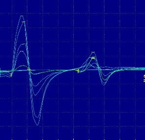 Hình ảnh phản xạ H Hình ảnh điện thế đơn vị vận động có biên độ 5