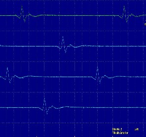 Hình ảnh phản xạ H Hình ảnh điện thế đơn vị vận động có biên độ 6