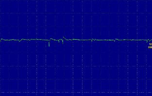 Hình ảnh điện thế tự phát sóng nhọn dương tại cơ chày trước Hình ảnh 7