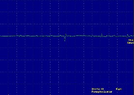 Hình ảnh điện thế tự phát sóng nhọn dương tại cơ chày trước Hình ảnh 8