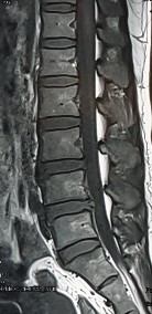 Hình ảnh thoát vị đĩa đệm trên phim chụp MRI 2 Hình ảnh khảo sát dẫn 9