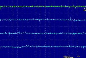 Hình ảnh bệnh nhân vận động khi khảo cơ cạnh sống Hình ảnh nhiễu tiếp 2