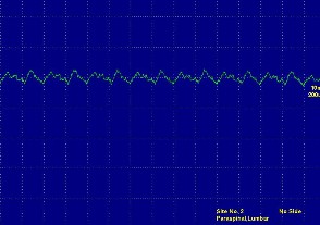 Hình ảnh nhiễu tiếp xúc do điện cực Hình ảnh nhiễu tiếp xúc do điện cực 3