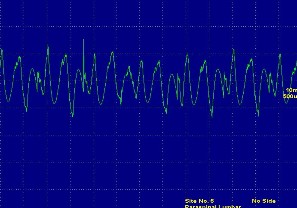 Hình ảnh nhiễu tiếp xúc do điện cực Hình ảnh nhiễu tiếp xúc do điện cực 4