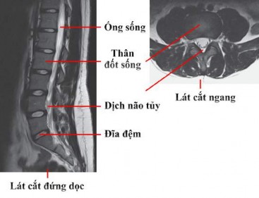 Hình 1 7 Hình ảnh chụp cộng hưởng từ cột sống thắt lưng 44 Hình ảnh 1