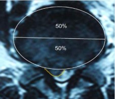 Hình 1 8 Hình ảnh cách xác định vị trí đĩa đệm bị thoát vị 45 Các 1