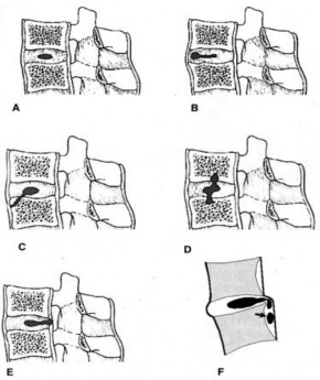 Hình 1 9 A Vị trí bình thường B Thoát vị ra trước C Thoát vị vào thân 2