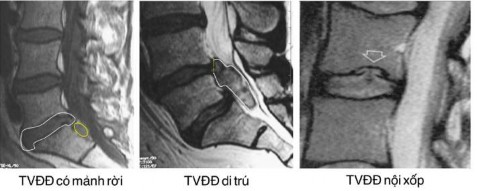 Hình 2 2 Hình ảnh cách xác định thoát vị đĩa đệm có mảnh rời 45 Hình 1