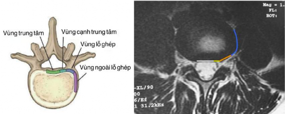 Hình 2 3 Hình ảnh cách xác định thoát vị đĩa đệm liên quan đến rễ thần 2
