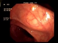 A B C Hình 4 1 Hình ảnh trên nội soi ống mềm u cơ vân tại đại tràng trái A 1