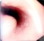 B C Hình 4 1 Hình ảnh trên nội soi ống mềm u cơ vân tại đại tràng trái A u 2