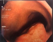 C Hình 4 1 Hình ảnh trên nội soi ống mềm u cơ vân tại đại tràng trái A u 3