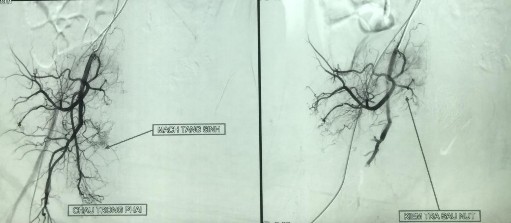 Hình 4 2 Hình ảnh chụp mạch trước và sau can thiệp nút mạch Chụp mạch thấy 4