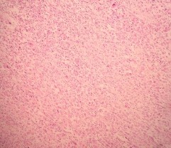 B Hình 4 3 A HE x 100 Các tế bào u hình thoi sắp xếp thành bó B HE x 400 Bào 1