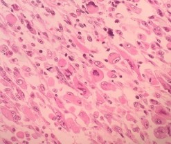 Hình 4 3 A HE x 100 Các tế bào u hình thoi sắp xếp thành bó B HE x 400 Bào 2