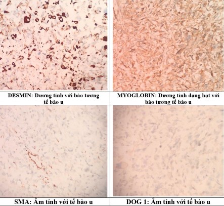 Hình 4 5 Hình ảnh nhuộm HMMD u cơ vân ác tính Liposarcoma trong 7 ca có một 4