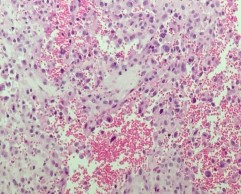 B Hình 4 7 A HE x 100 Các tế bào u dạng biểu mô xen kẽ là các mạch máu B 6