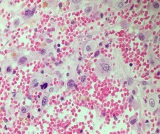 Hình 4 7 A HE x 100 Các tế bào u dạng biểu mô xen kẽ là các mạch máu B HE x 7