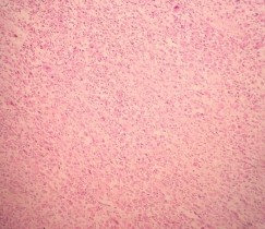 HE x 100 Các tế bào u hình thoi sắp xếp thành bó HE x 400 Bào tương tế bào u 1