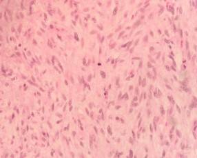 HE x 100 Thành phần u mất biệt hóa với các tế bào u hình thoi nhân bầu HE x 10