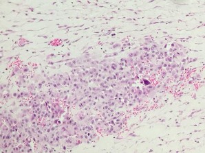 HE x 100 Các tế bào u dạng biểu mô xen kẽ là các mạch máu HE x 100 Các tế 11