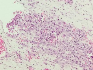 HE x 100 Các tế bào u dạng biểu mô xen kẽ là các mạch máu HE x 100 Các tế 12