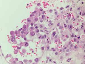 HE x 100 Các tế bào u dạng biểu mô xen kẽ là các mạch máu HE x 400 Rõ hạt 14