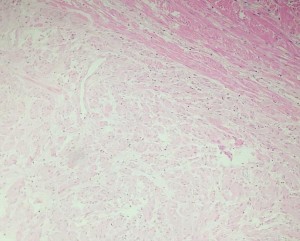 HE x 100 Tế bào u hình thoi nhân bầu sắp xếp thành bó HE x 400 Tế bào u hình 17