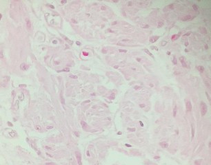 HE x 100 Tế bào u hình thoi nhân bầu sắp xếp thành bó HE x 400 Tế bào u hình 18