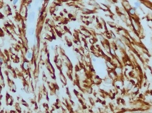 DOG1 Dương tính mạnh với nhân và bào tương CD117 Dương tính với bào tương 19