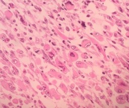 HE x 100 Các tế bào u hình thoi sắp xếp thành bó HE x 400 Bào tương tế bào u 2