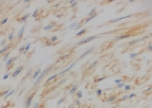 DOG1 Dương tính mạnh với nhân và bào tương CD117 Dương tính với bào tương 20