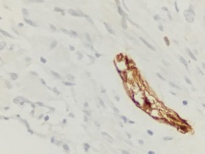 S100 Âm tính với tế bào u dương tính với chứng nội SMA Âm tính với tế 21