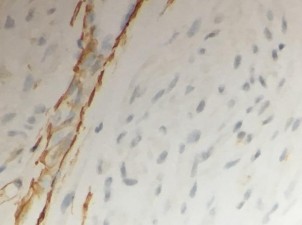 S100 Âm tính với tế bào u dương tính với chứng nội SMA Âm tính với tế 22