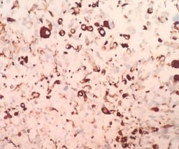 DESMIN Dương tính với bào tương tế bào u MYOGLOBIN Dương tính dạng hạt với 3