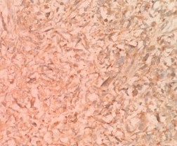 DESMIN Dương tính với bào tương tế bào u MYOGLOBIN Dương tính dạng hạt với 4