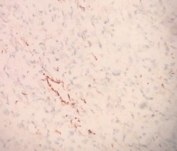 SMA Âm tính với tế bào u DOG 1 Âm tính với tế bào u 2 U mỡ ác tính 5