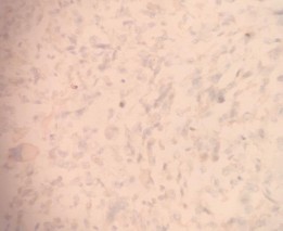 SMA Âm tính với tế bào u DOG 1 Âm tính với tế bào u 2 U mỡ ác tính 6