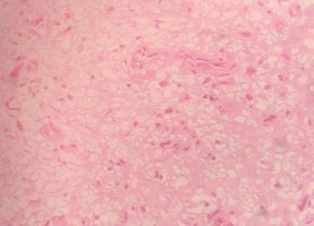 HE x 100 Thành phần u biệt hóa cao với các tế bào u có không bào rộng nhân ở 7