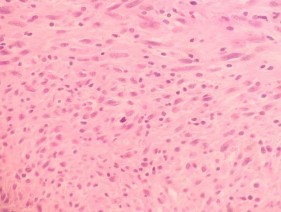 HE x 100 Thành phần u biệt hóa cao với các tế bào u có không bào rộng nhân ở 8