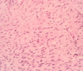 HE x 100 Thành phần u mất biệt hóa với các tế bào u hình thoi nhân bầu HE x 9