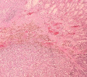 HE x 100 Tế bào u hình thoi nhân lớn rõ hạt nhân HE x 400 U giàu nhân chia bài 1