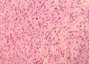 HE x 100 Các tế bào u hình thoi nhân bàu bào tương hồng sắp xếp thành bó HE x 10