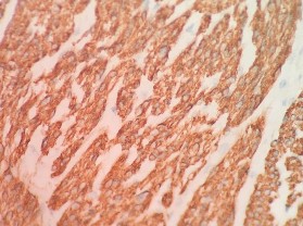 SMA Dương tính mạnh bào tương DESMIN Dương tính bào tương CALDESMON Dương tính 11